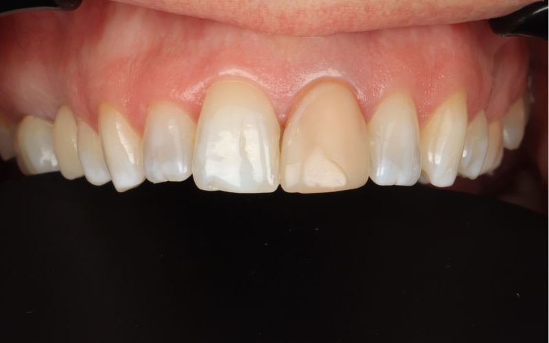 1-Before_композитная реставрация невитального зуба.jpg