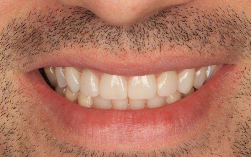 10-After_Композитный бондинг, используемый для восстановления изношенных зубов и улучшения эстетики 2