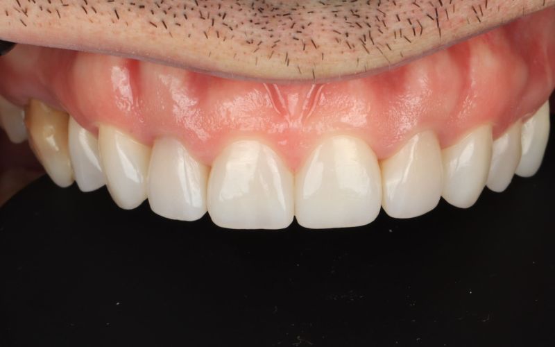 10-After_Композитный бондинг, используемый для восстановления изношенных зубов и улучшения эстетики