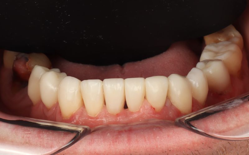 7-After_Композитный бондинг, используемый для восстановления изношенных зубов и соответствия верхним керамическим реставрациям 2