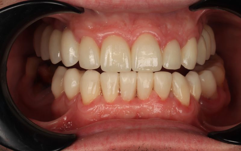 7-After_Composite klijavimas, naudojamas susidėvėjusiems dantims atkurti ir derinti prie viršutinių keraminių restauracijų