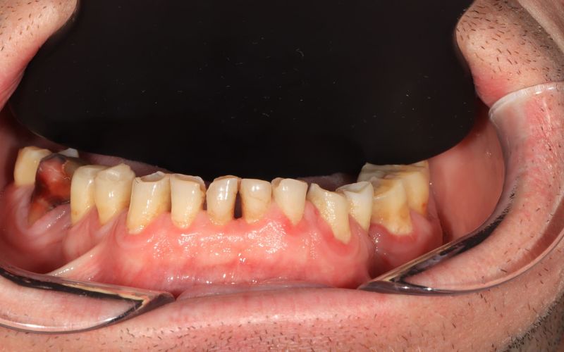 7-Before_Composite klijavimas, naudojamas susidėvėjusiems dantims atkurti ir viršutinėms keraminėms restauracijoms derinti 2