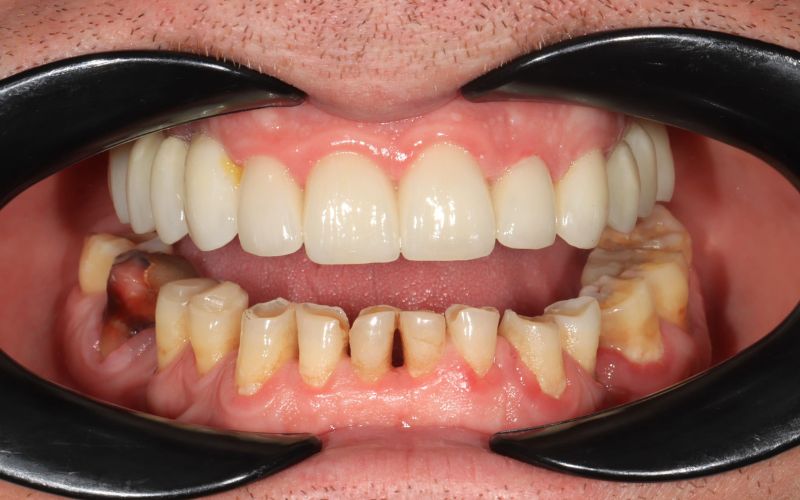 7-Before_Composite klijavimas, naudojamas susidėvėjusiems dantims atkurti ir derinti su viršutinėmis keraminėmis restauracijomis