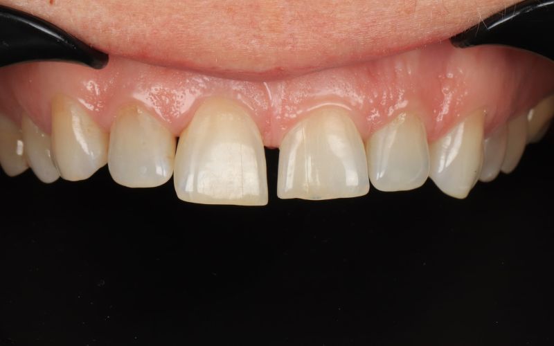 9-Before_Неинвазивная композитная фиксация, используемая для закрытия промежутков и изменения формы зубов.